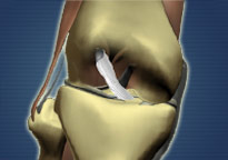 A Closer Look ACL Tear
